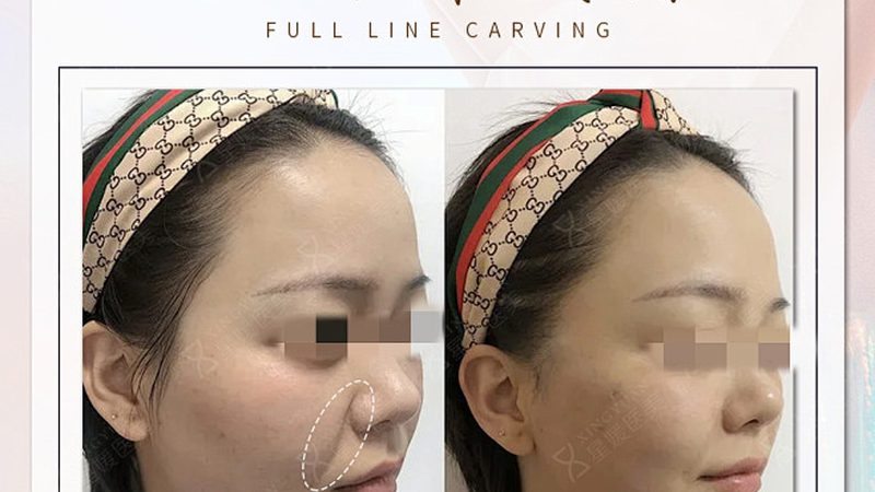光子嫩肤和激光哪个更安全