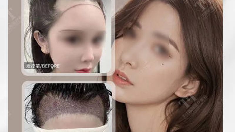 光子嫩肤：揭秘术前术后对比，揭秘轻医美奥秘