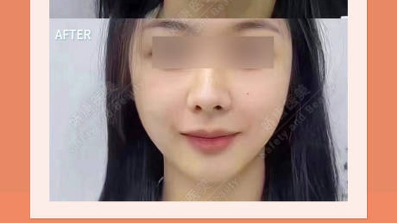 注射美容不适合哪些人