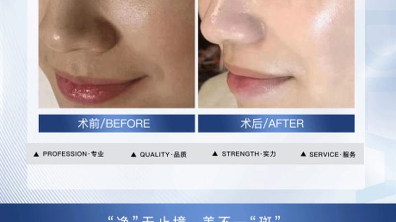 光子嫩肤后敷面膜用什么牌子好