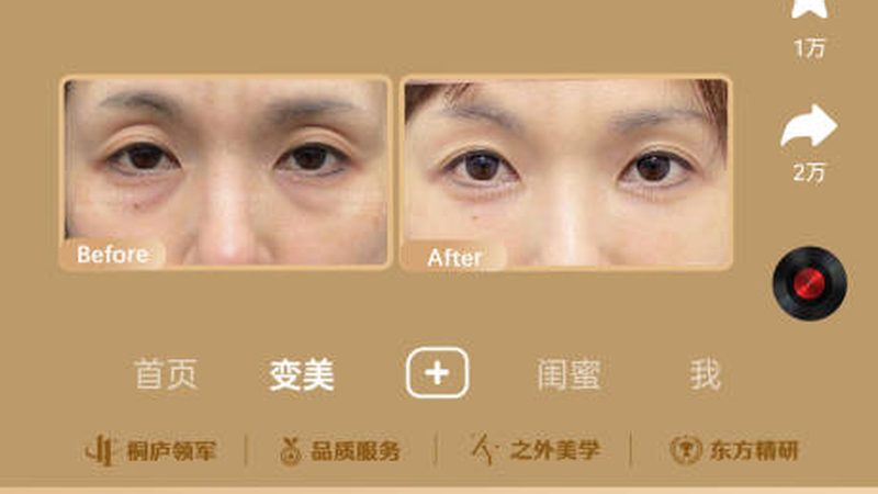 埋线提升后脸部凹凸不平？了解原因及应对措施